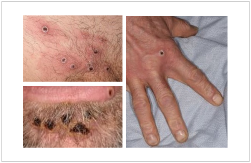 What Is Monkeypox: Symptoms, Pictures, and Treatment