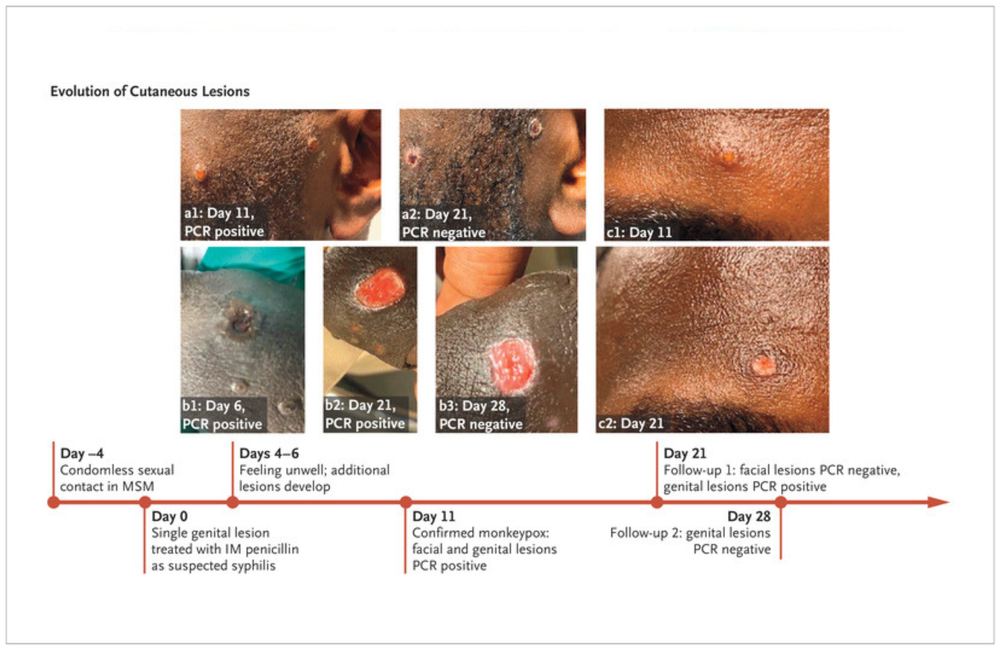 What Does Monkeypox Feel Like? How Two People Describe the Pain - GoodRx